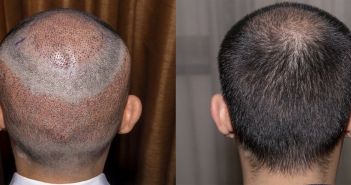 Türkei etabliert sich als führendes Ziel für Haartransplantationen (Foto: AdobeStock - Sugrit - 290465761)